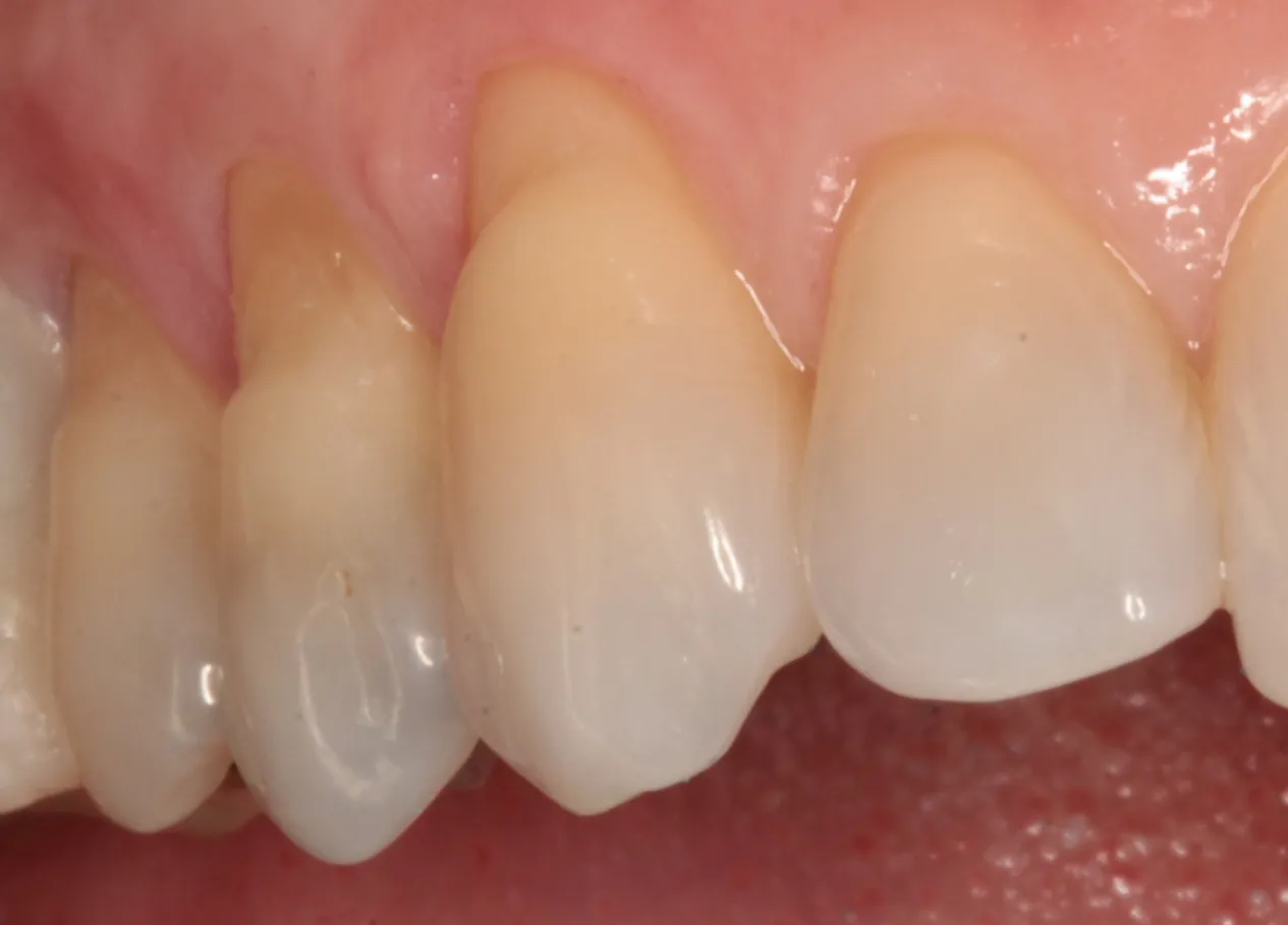 How to restore Class V restorations with EPIC-TMPT