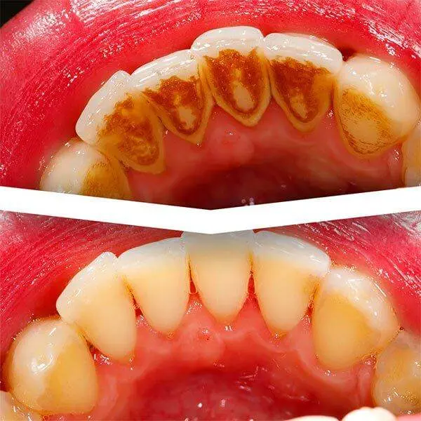 dental-cleanig (1)