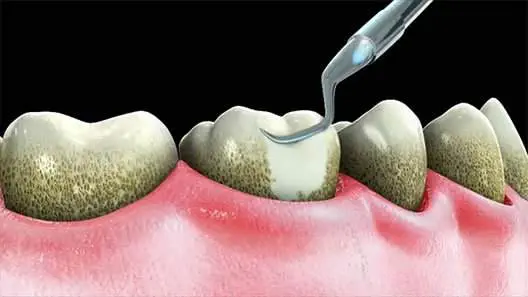 teeth-cleaning-1