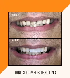 Direct Composite Filling