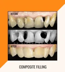 Composite Filling