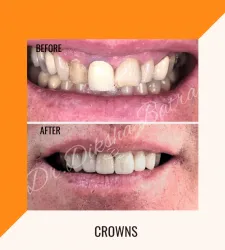 Crowns - clinic