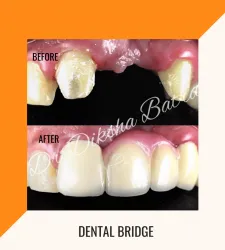 Dental Bridge