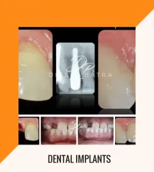 Dental Implants