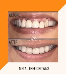 Metal Free Crowns