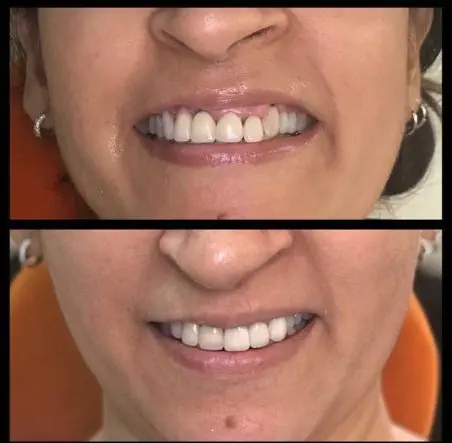 dental bridge 1 dental bridge 1