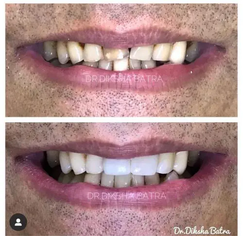 dental bridge 2 dental bridge 2