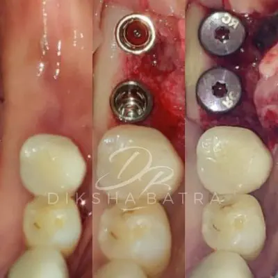 dental implants dental implants