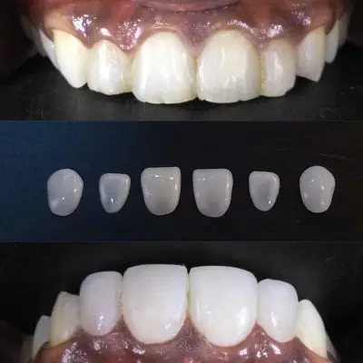 digital smile design digital smile design