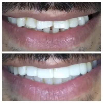 smile design smile design