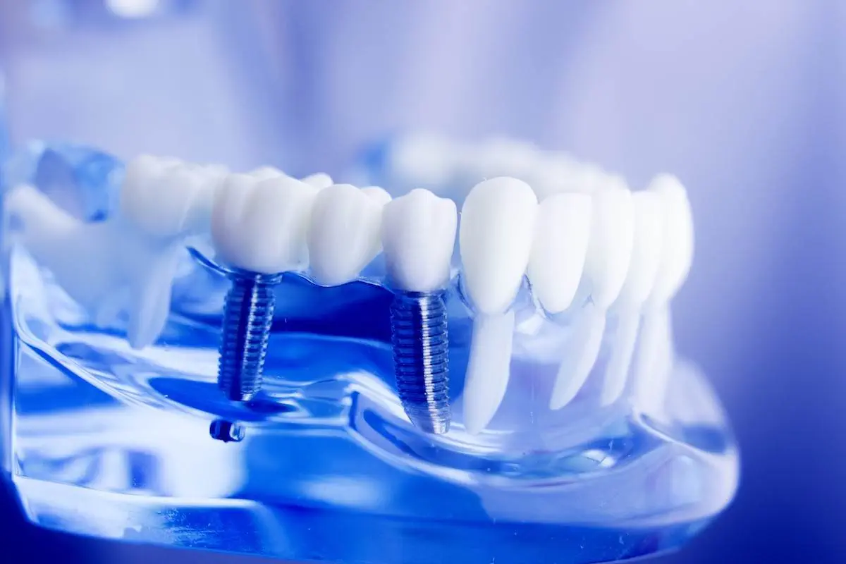 610279277ae2425e8a77ca1bf272bc56_dental-implants-1200-c-90