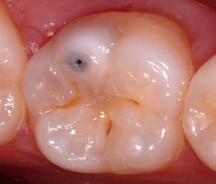 NOT ALL CAVITIES REQUIRE DENTAL FILLING! 5 TOOTH CONDITIONS WHICH CAN BE TREATED WITHOUT IT