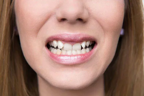 ADVANCED TEETH STRAIGHTENING OPTIONS