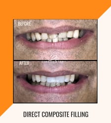 Direct Composite Filling