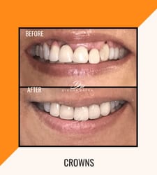 Crowns